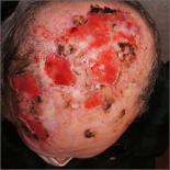 Nonhealing postsurgical scalp ulcers