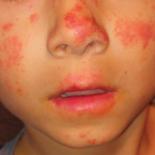Pruritic photosensitive rash