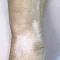 Linear hypopigmentation on the right arm 
