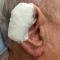 Pressure bandage on the ear, a traditionally hard-tobandage site. The elasticity of the tape conforms to the helical rim. Pressure bandage on the ear, a traditionally hard-tobandage site. The elasticity of the tape conforms to the helical rim.
