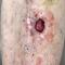 A wound on the left pretibial region following Mohs micrographic surgery