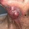 Patient 8 before treatment with a cluster of tumors on the neck 2.5 to 6 cm in diameter Patient 8 before treatment with a cluster of tumors on the neck 2.5 to 6 cm in diameter