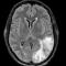 Magnetic resonance imaging of the brain obtained in the emergency department at the time of presentation showed innumerable peripherally distributed foci of microhemorrhage and vasogenic edema within the left parietal-occipital-temporal lobes.