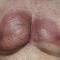 Erythematous, edematous, indurated, asymptomatic plaques with a peau d’orange appearance on the bilateral pectoral and presternal regions with minimal retraction of the right areola.