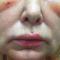 A 60-year-old woman with periorbital, facial, and lip edema. 