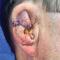 Primary repair of a surgical wound on the right ear.