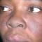 A Black woman with malar erythema and hyperpigmentation from acute cutaneous lupus erythematosus. The nasolabial folds are spared