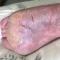 Hyperkeratosis, fissuring, and erythema of the plantar foot before guselkumab was initiated.