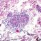 Nonnecrotizing granuloma with scant surrounding lymphocytes was present (H&E, original magnification ×200). Nonnecrotizing granuloma with scant surrounding lymphocytes was present (H&E, original magnification ×200).