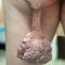 Pedunculated verrucous tumor on the buttock