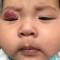As this 4-month-old infant grew, so did the lesion