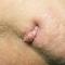 Chin lesion Chin lesion