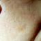 Cheek lesion Cheek lesion