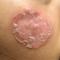 Cheek lesion Cheek lesion