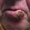 Lip lesion Lip lesion