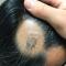 Hair loss Hair loss