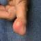 Finger lesion Finger lesion