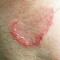 Itchy lesion Itchy lesion