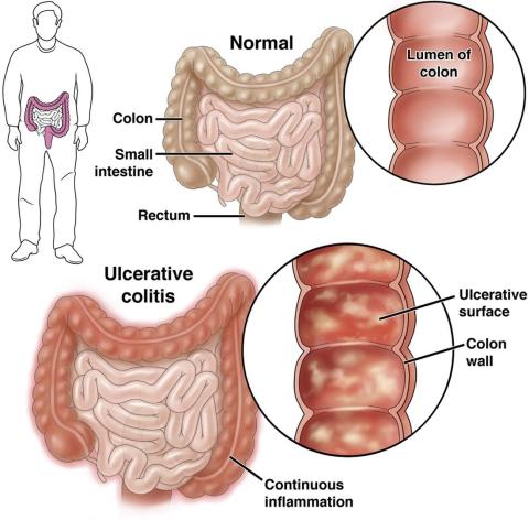 AGA’s new ulcerative colitis toolkit is a comprehensive resource to support IBD patient care.