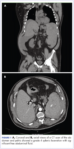 Figure 1 Coronal and axial views of a CT scan of the abdomen and pelvis showed a grade 4 splenic laceration with significant free abdominal fluid