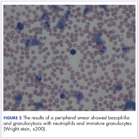 Figure 2 The results of a peripheral smear showed basophilia and granulocytosis with neutrophils and immature granulocytes