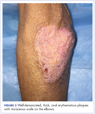 Figure 3 Well-demarcated, thick, oval erythematous plaques with micaceous scale on the elbows.