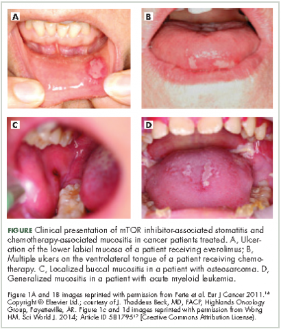 Figure Clinical presentation omTOR-inhibitor-associated stomatitis