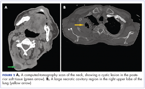 Figure 2 A computed-tomography scan of the neck, showing a cystic lesion in the posterior soft tissue and large necrotic cavitary region in the right upper lobe of the lung