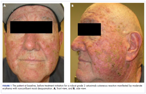 Figure 1 The patient at baseline, before treatment, front and side views