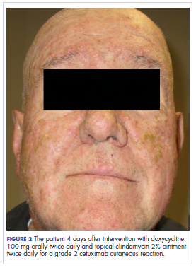 Figure 2 The patient 4 days after treatment initiation.