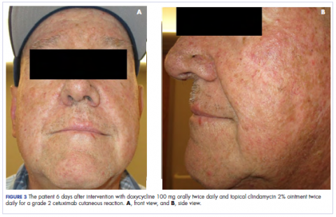 Figure 3 The patient 6 days after intervention with doxycycline, front and side views.