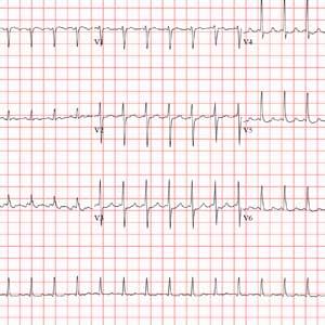 ECG