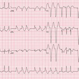 ECG