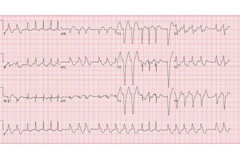 ECG