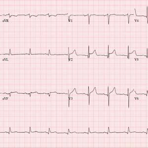 Electrocardiogram