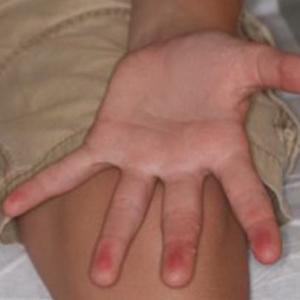 Blanchable Erythematous Patches on the Fingers