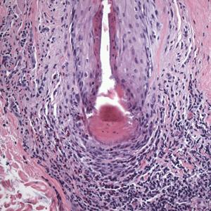 Hair Follicle Bulb Region: A Potential Nidus for the Formation of Osteoma Cutis