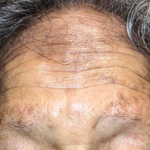Hyperpigmentation on the Head and Neck