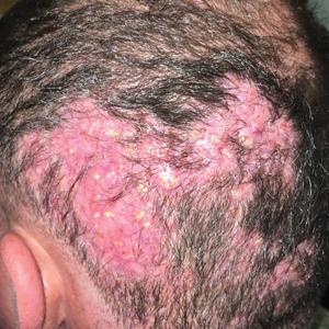 head with rash