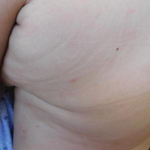 Itchy bumps