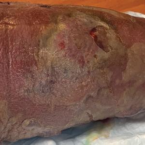 Lower leg lesion