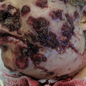 Numerous beefy-red, heaped-up, weepy, crusted nodules clustered on the face. An endotracheal tube was placed shortly after admission due to rapidly declining mental status. 