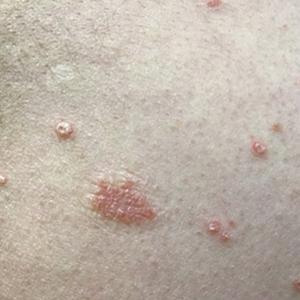 Guttate psoriasis that manifested as erythematous, silvery, scaly papules 3 weeks after COVID-19 infection