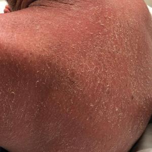 Diffuse erythema and scaling of the back.