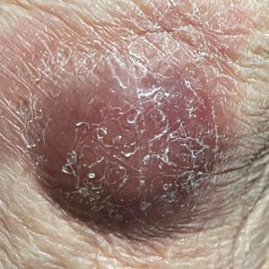 Violaceous nodules on the lower leg