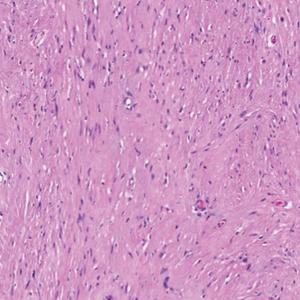 Histopathology of a fully encapsulated schwannoma with cystic areas and hemorrhagic areas 