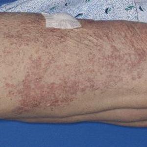 Dermatomal distribution of grouped erythematous papules 