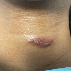 Vascular plaque