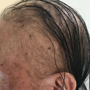 Alopecia with preferential sparing of the occipital scalp.
