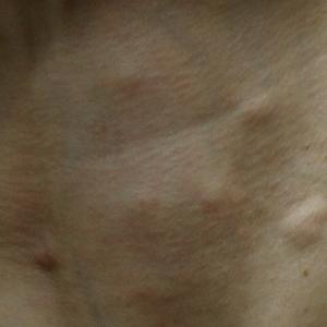 Multiple subcutaneous nodules developed on the neck 3 weeks after poly-L-lactic acid injection.